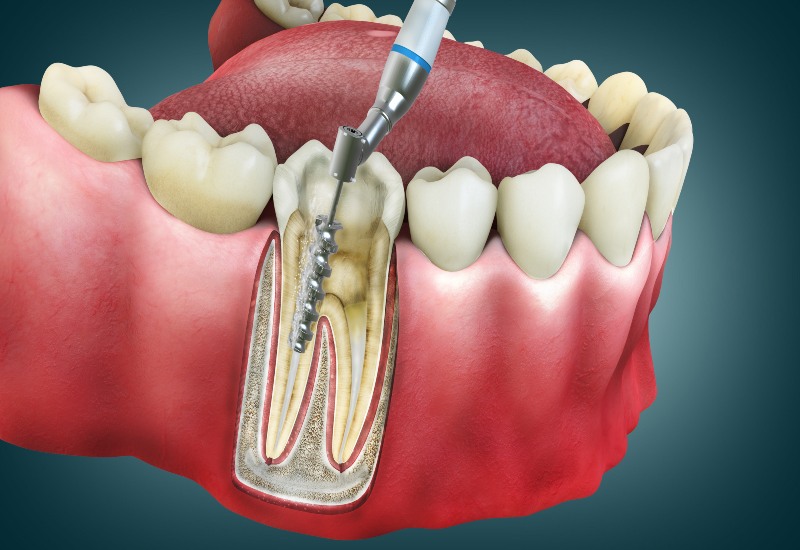 A 3D view of root canal treatment cleaning infected tooth pulp in Millersburg, OH