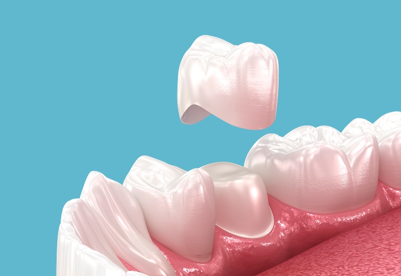 A 3D illustration of a dental crown placed on a prepared tooth in a dental arch in Millersburg, OH