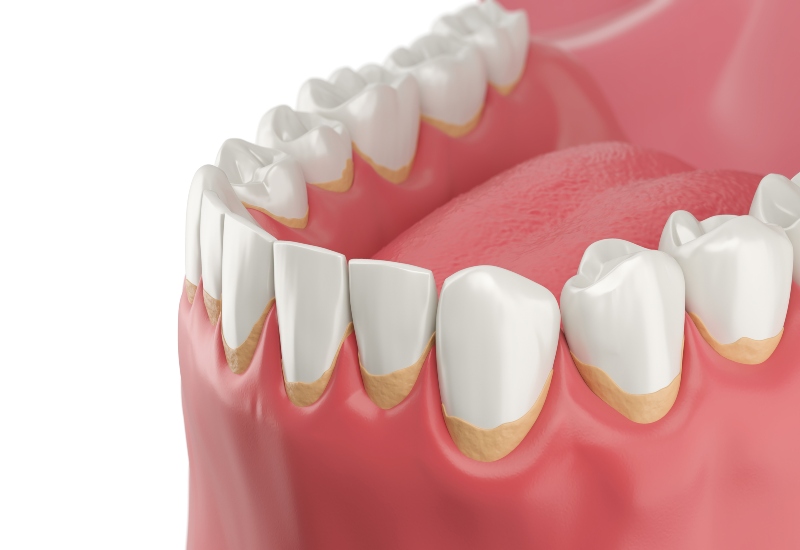 3D image of teeth with plaque on the gumline, showing the importance of oral hygiene in Millersburg