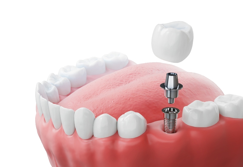 A 3D rendering of a dental implant system replacing a missing tooth in Millersburg, OH