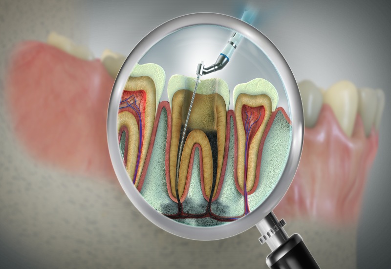 A 3D illustration of a magnified root canal treatment procedure in Millersburg, OH