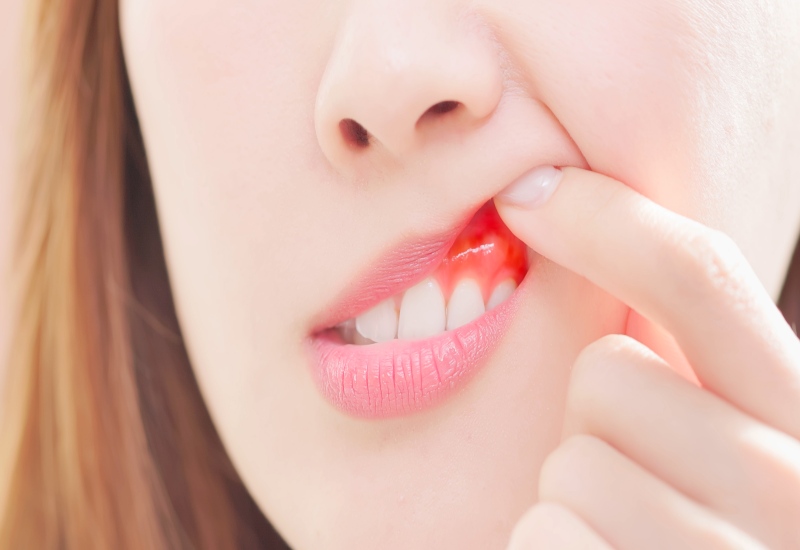 A close-up of inflamed gums and exposed teeth showing signs of gum recession in Millersburg, OH