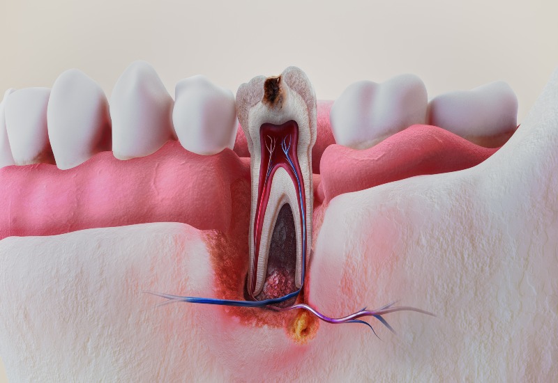 A 3D cross-section of a tooth showing decay, pulp infection, and abscess in Millersburg, OH