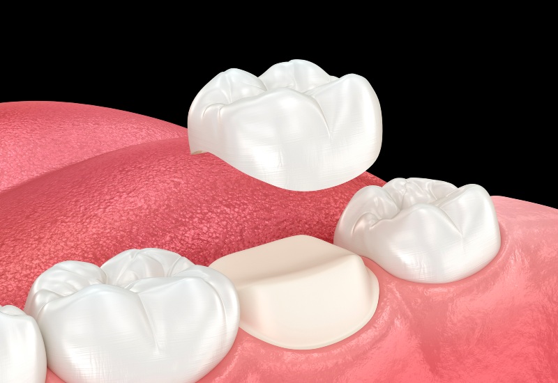 A 3D rendering of the dental crown placement process on molar teeth in Millersburg, OH